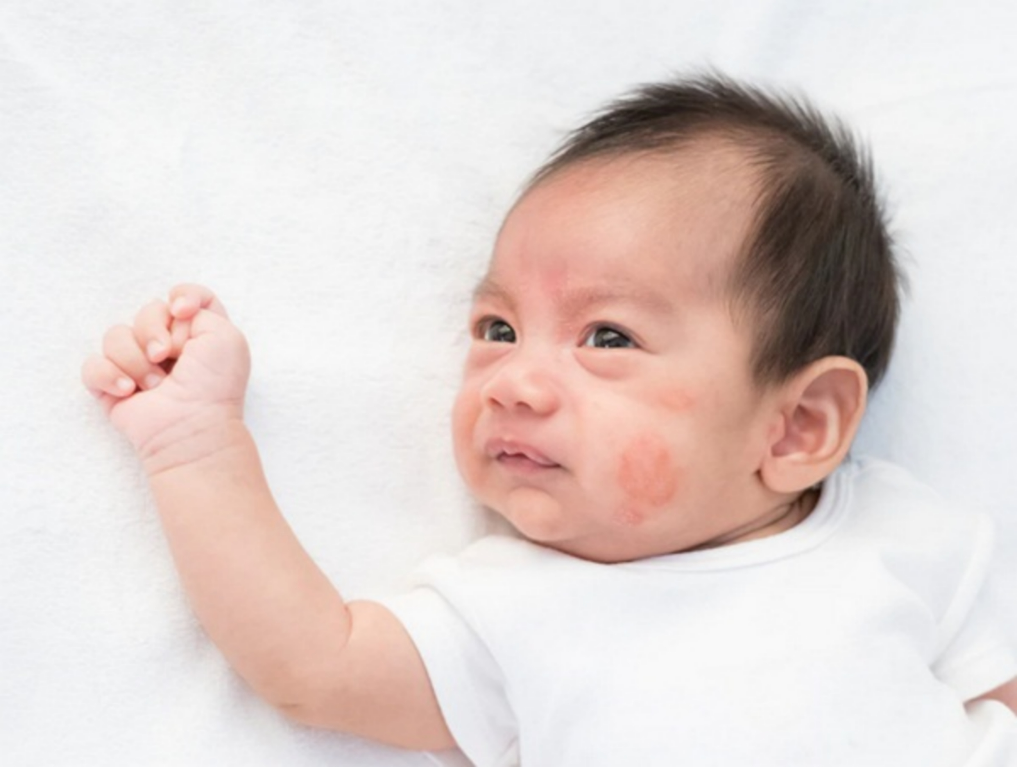 Các triệu chứng viêm da cơ địa ở trẻ nhỏ và cách điều trị