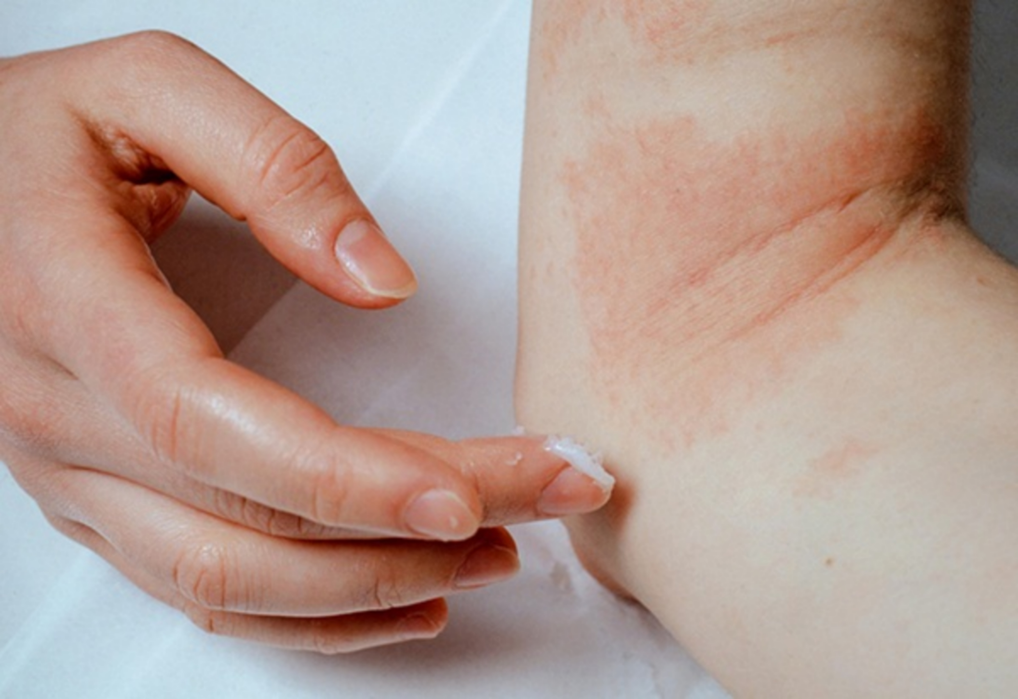 Tác dụng của dầu dừa trong điều trị viêm da cơ địa
