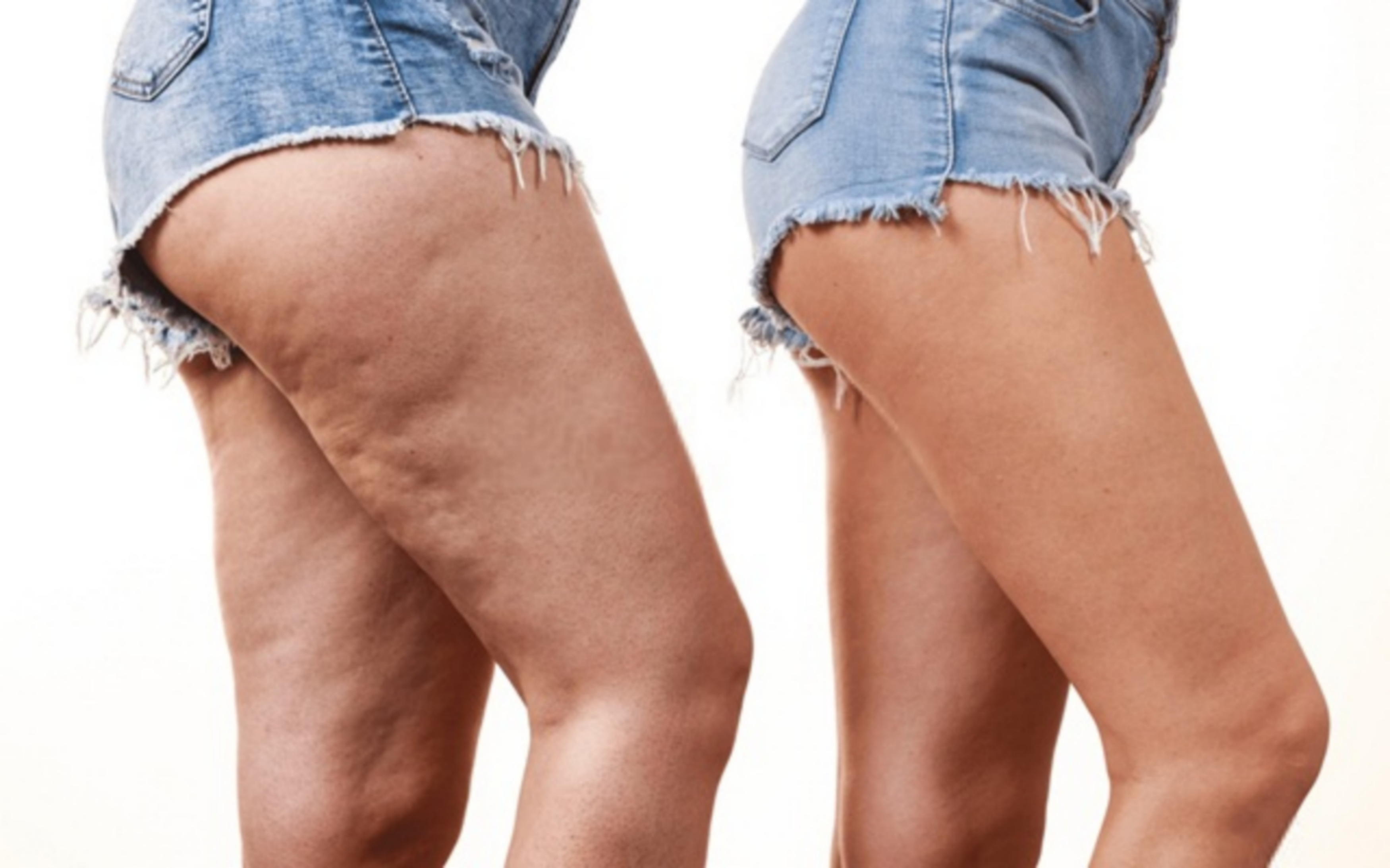 Điều trị da sần vỏ cam bằng dầu dừa