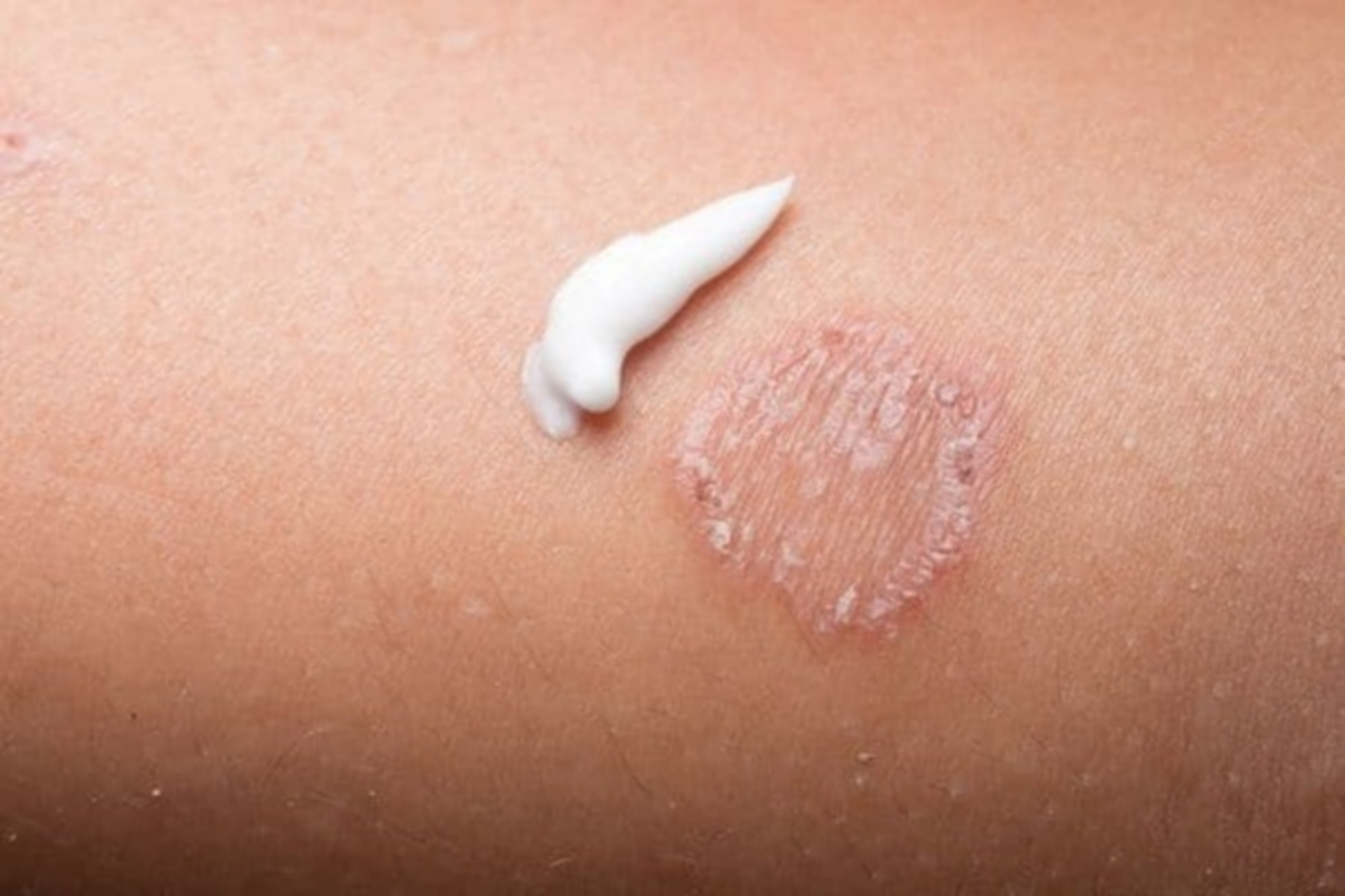 Điều trị hắc lào (nấm da) bằng dầu dừa có hiệu quả không?