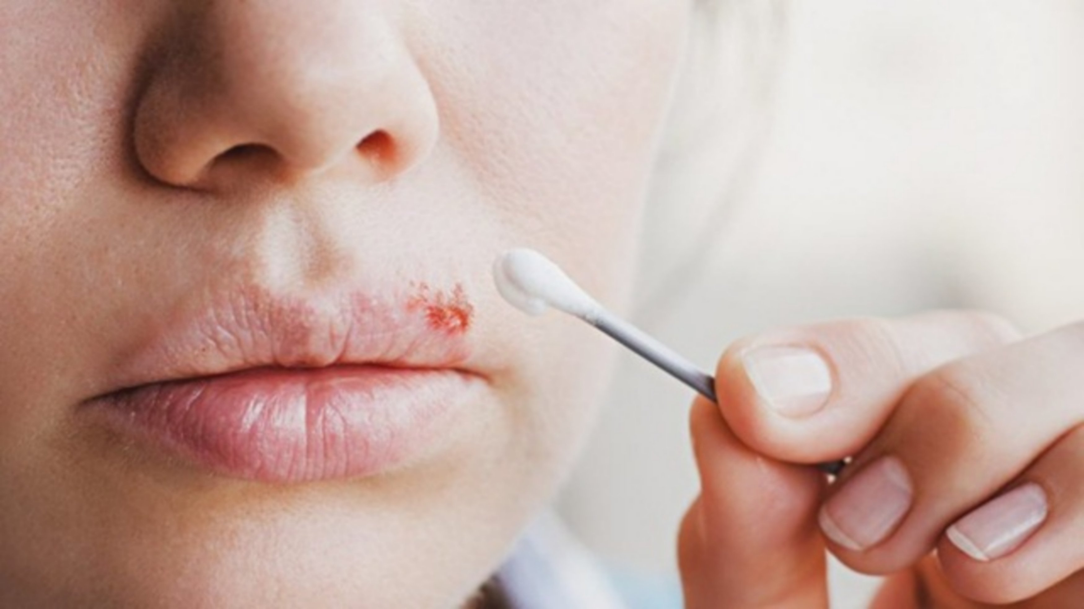 Các phương pháp trị mụn rộp (herpes) môi hiệu quả nhất