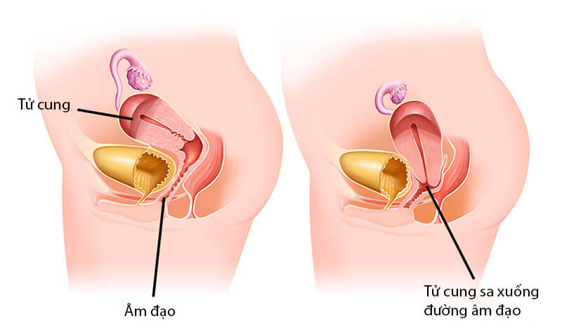 Sa dạ con