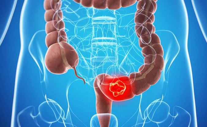 Bệnh nhân ung thư đầu tiên được chữa khỏi hoàn toàn