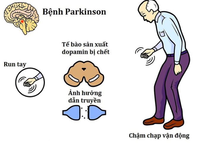 Bệnh parkinson có nguy hiểm không? Nguyên nhân & cách điều trị