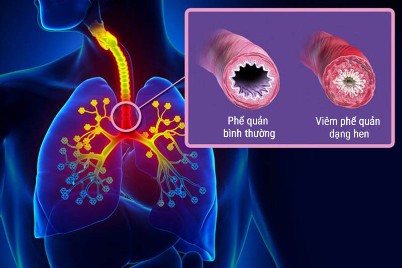 Chẩn đoán hen phế quản ở người lớn phân biệt với các bệnh khác