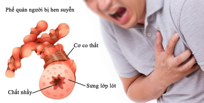Bệnh hen phế quản xảy ra khi tình trạng đường thở bị sưng hẹp