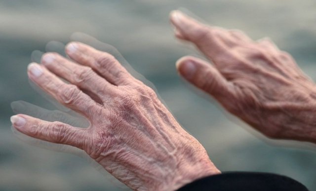 Bệnh Parkinson là căn bệnh liên quan tới thần kinh và run tay là biểu hiện rõ nhất