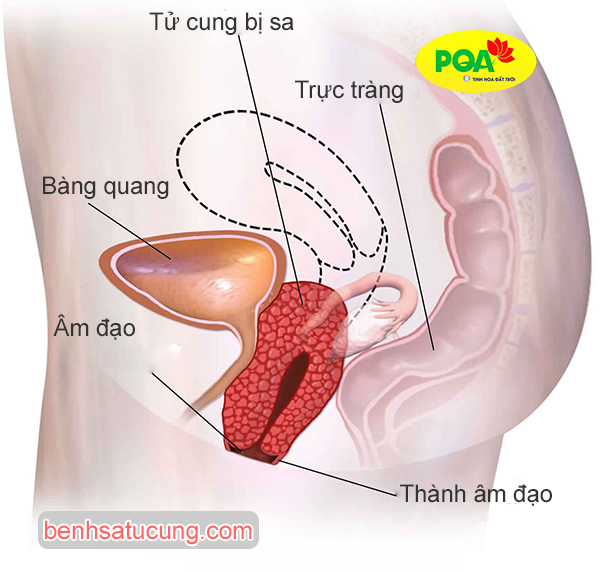 Bật mí kinh nghiệm chữa sa tử cung cho chị em phụ nữ
