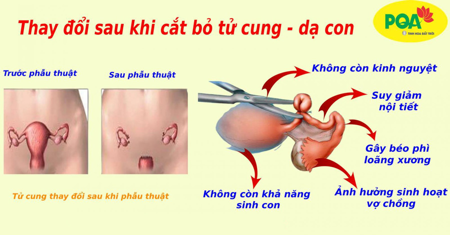 Những thay đổi sau khi cắt bỏ tử cung người bệnh cần đối mặt