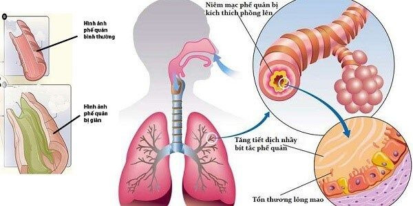 Thuốc trị hen phế quản