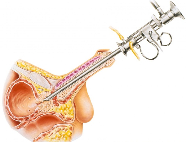 Các biến chứng của phẫu thuật phì đại tuyến tiền liệt