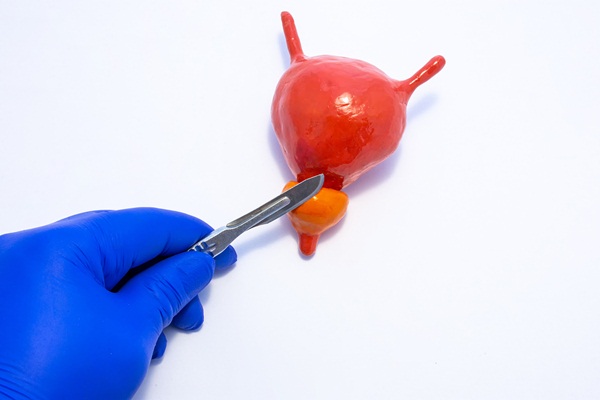 Cắt bỏ tuyến tiền liệt có ảnh hưởng đến tuổi thọ không?