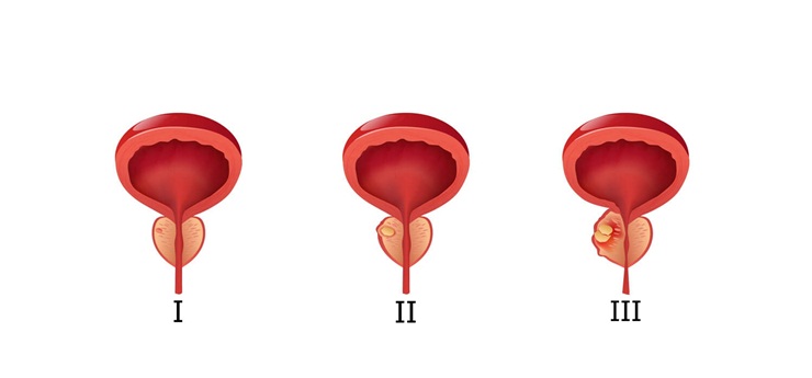 Ung thư tuyến tiền liệt giai đoạn 3: Triệu chứng, điều trị và tiên lượng