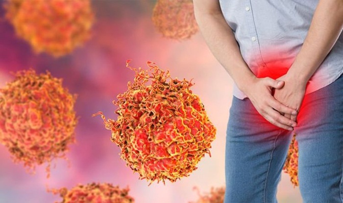7 dấu hiệu thường gặp của ung thư tuyến tiền liệt di căn
