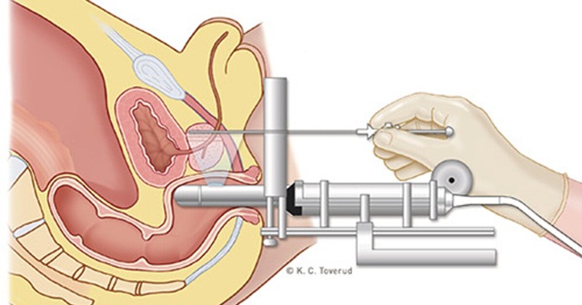 Điều trị ung thư tuyến tiền liệt bằng xạ trị áp sát