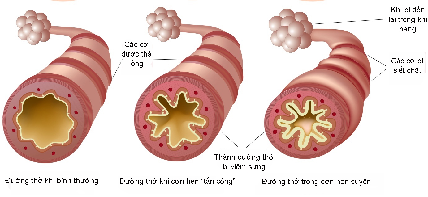 Nếu không điều trị hen suyễn kịp thời dễ để lại biến chứng