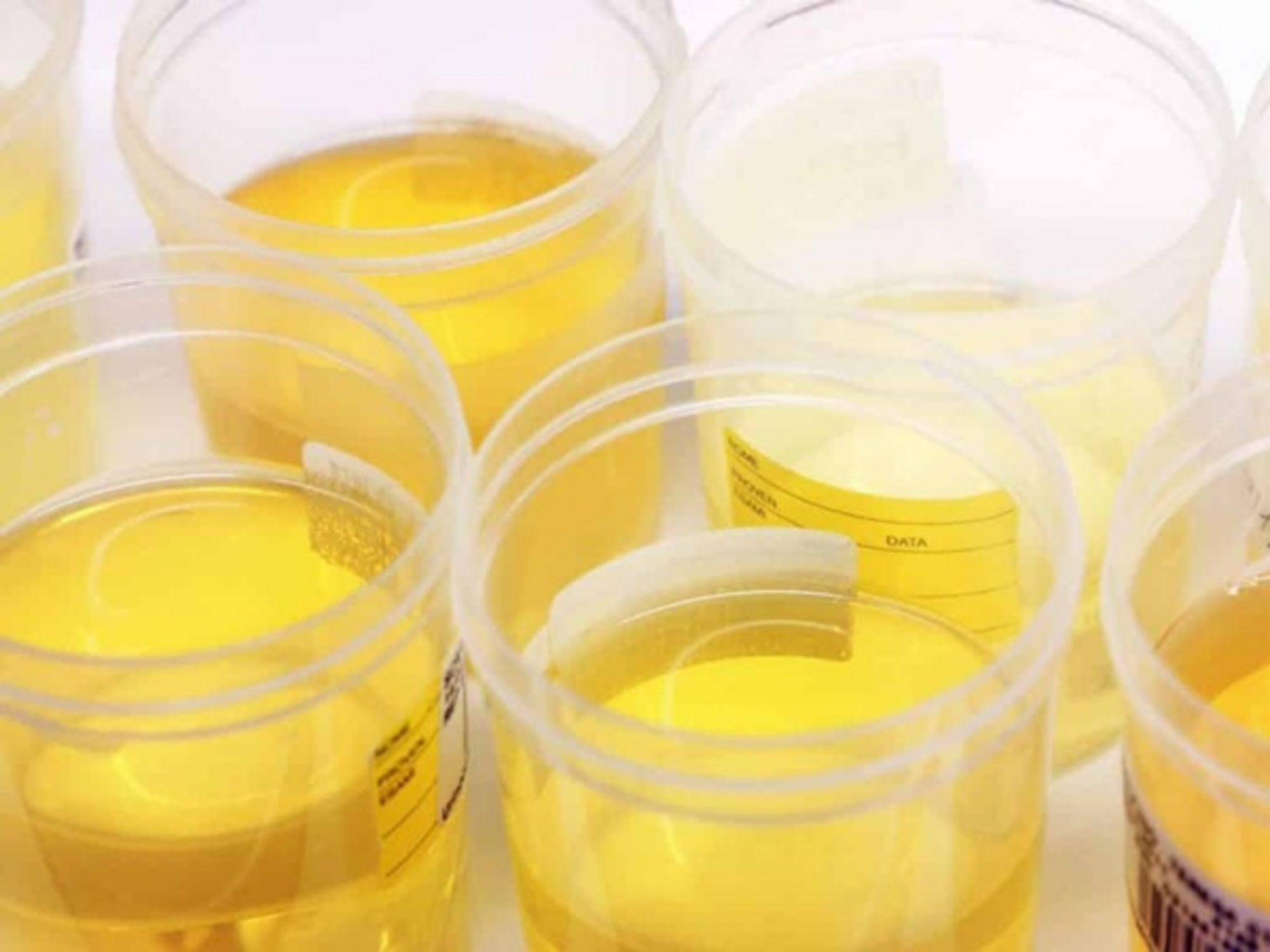 Nước tiểu có màu vàng tươi là do đâu?