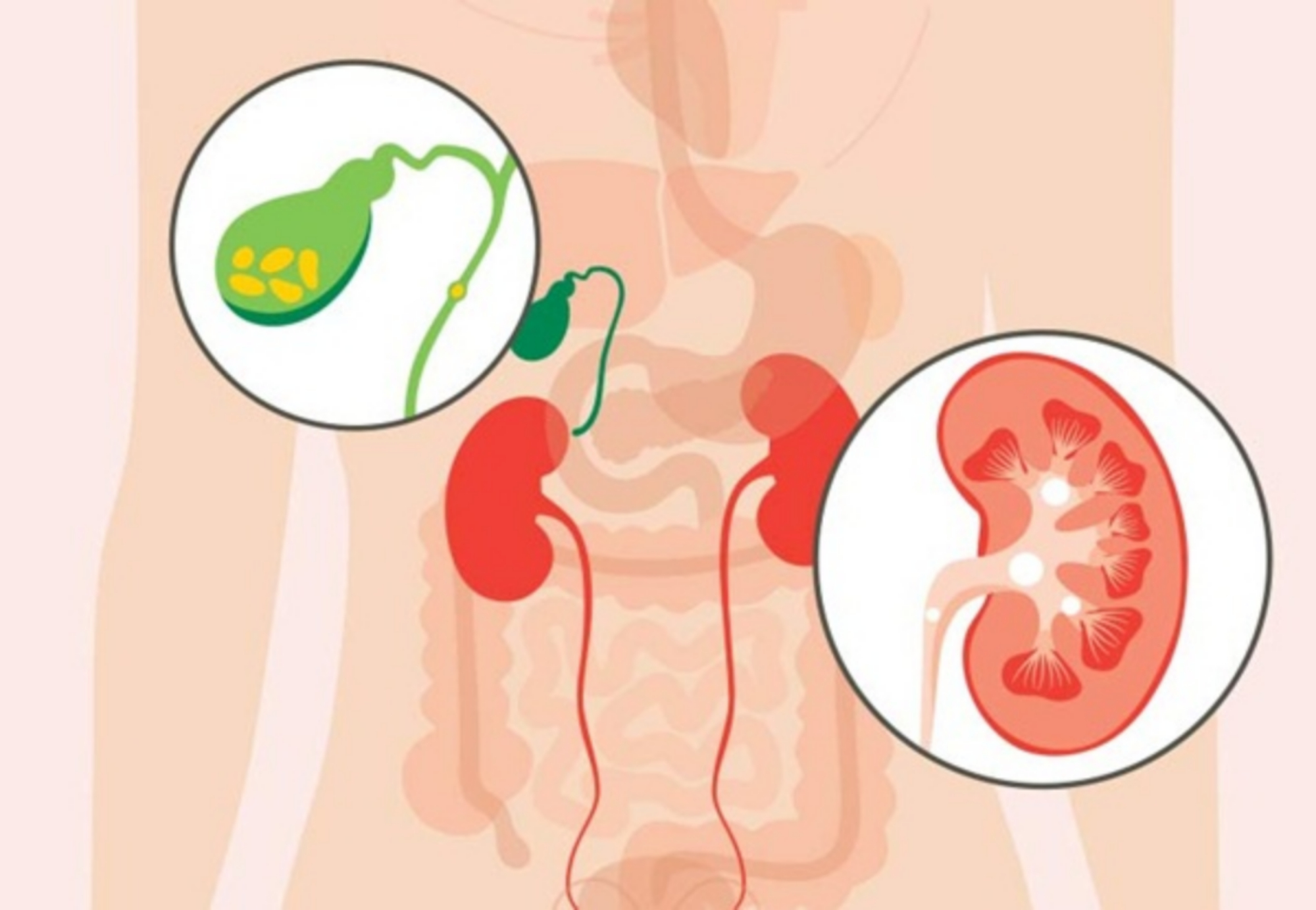 Sỏi mật và sỏi thận có gì giống và khác nhau?