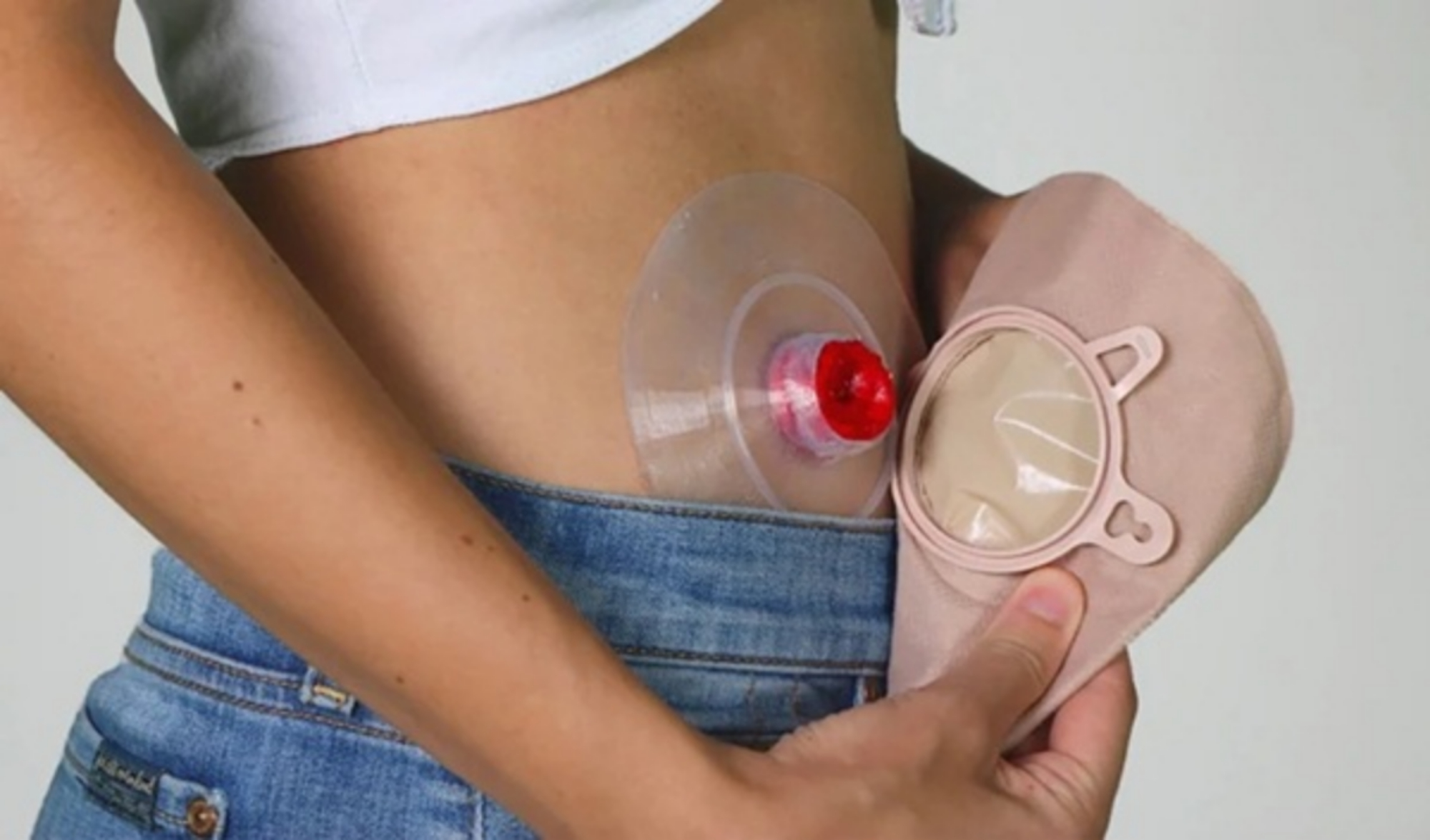 Những điều cần biết về phẫu thuật mở thông niệu quản ra da