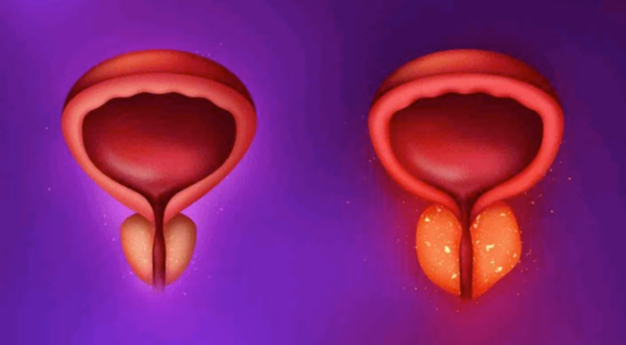 Viêm tuyến tiền liệt mạn tính do nhiễm khuẩn đièu trị bằng cách nào?