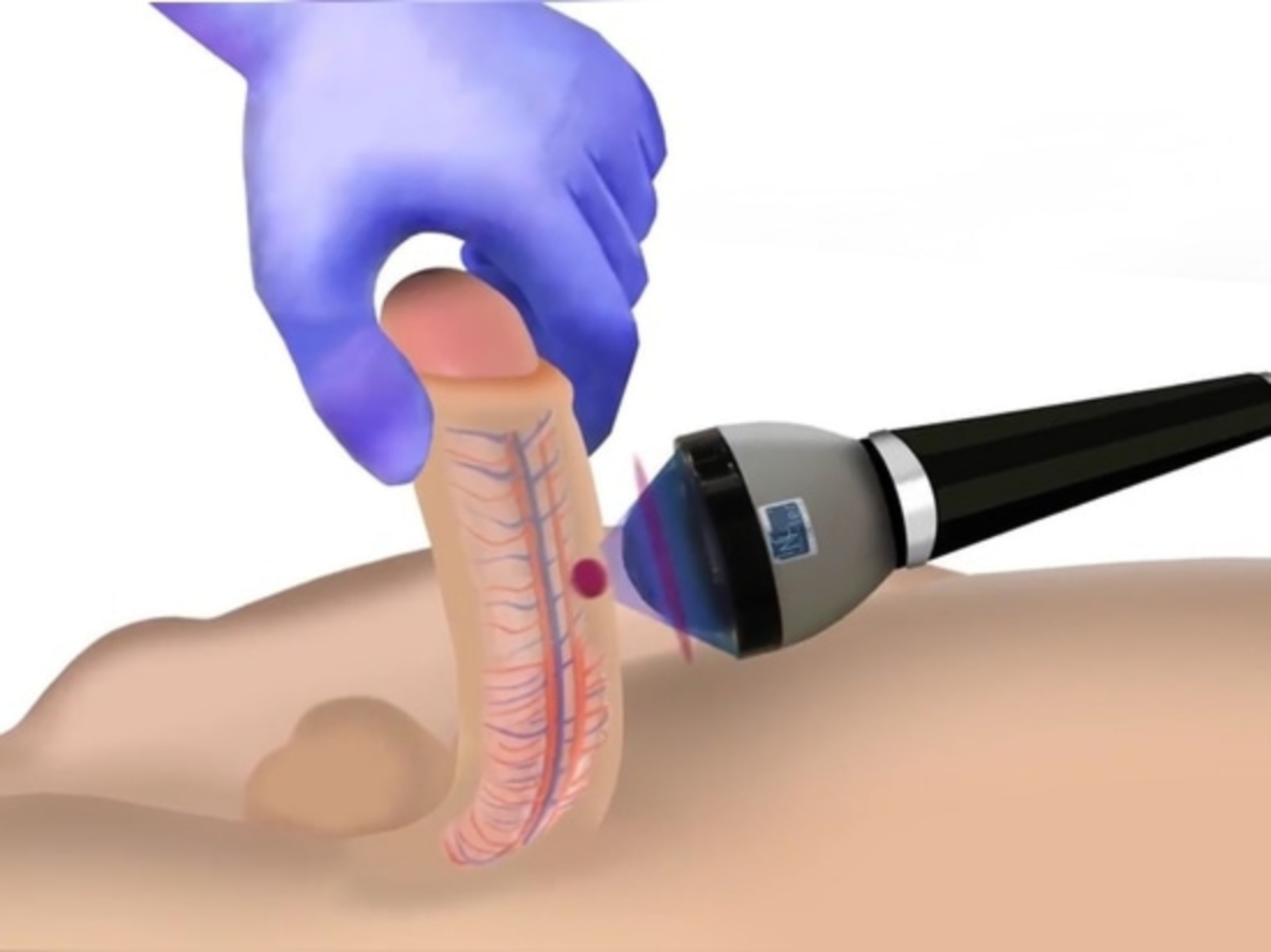 Điều trị rối loạn cương dương bằng sóng xung kích (shockwave therapy) có hiệu quả không?