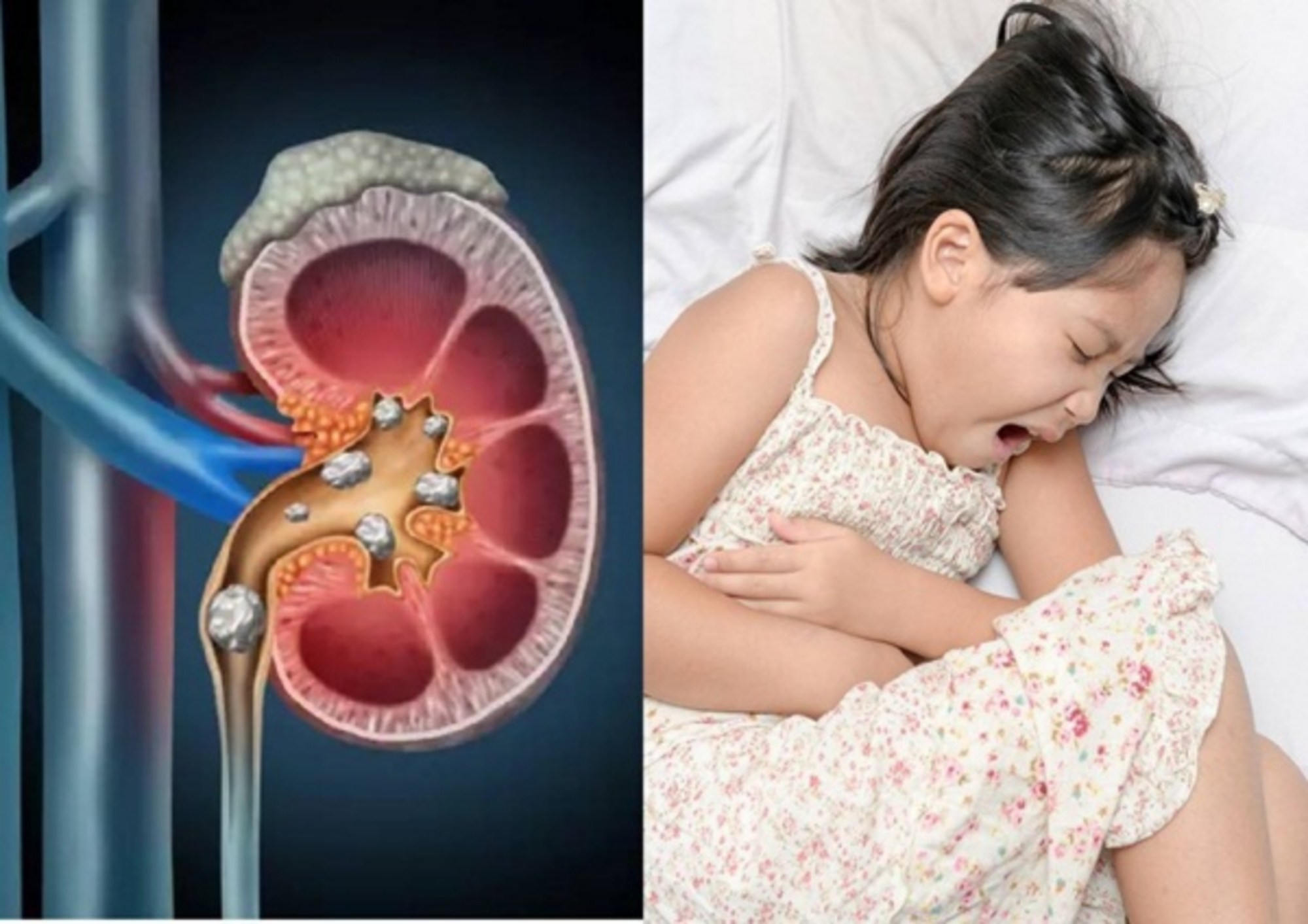 Trẻ em có bị sỏi thận không?