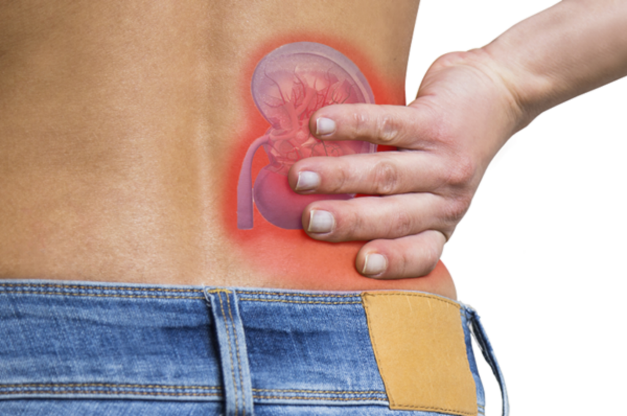 Tiêu chảy có phải triệu  chứng của sỏi thận không?