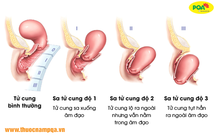 3 cấp độ sa tử cung thường gặp