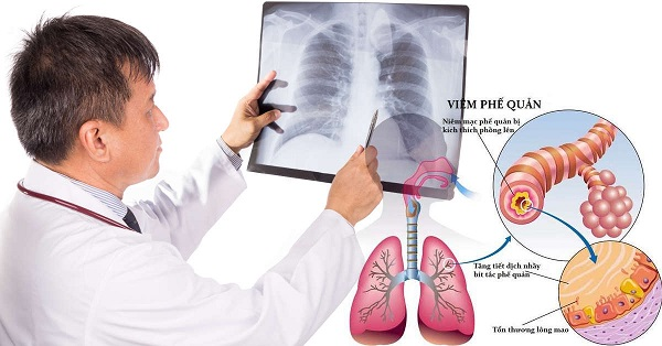 Điều trị hen suyễn triệt để không dùng thuốc như thế nào?
