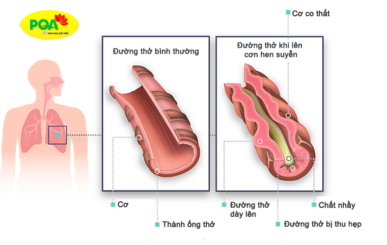 Hình ảnh đường thở của người mắc bệnh hen suyễn