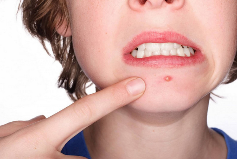 Cách giảm đau khi mụn trứng cá kỳ kinh xuất hiện