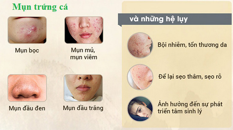 Cách trị mụn trứng cá kinh nguyệt và phân biệt