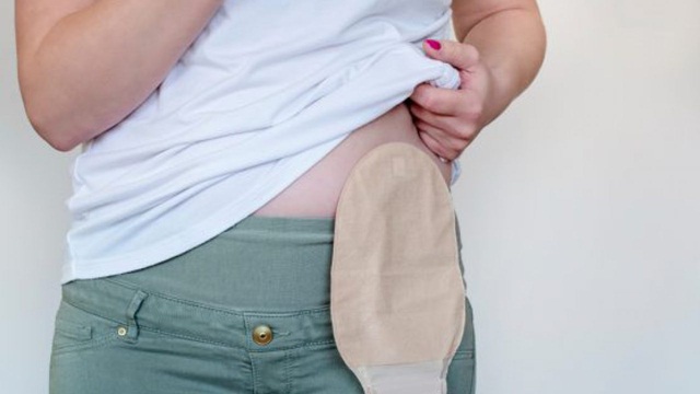 Những điều cần lưu ý sau phẫu thuật chuyển lưu dòng tiểu