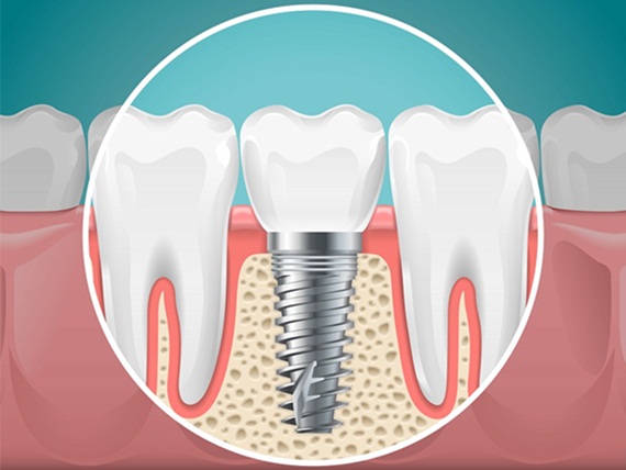 Người bị loãng xương có thể trồng răng implant không?