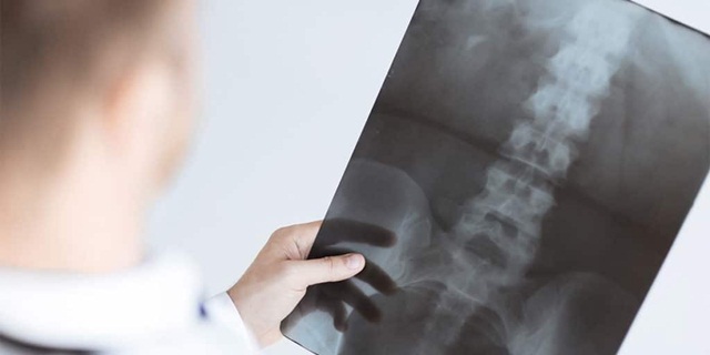 Mối liên hệ giữa loãng xương và thoái hóa đĩa đệm