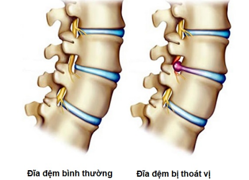 thoát vị đĩa đệm