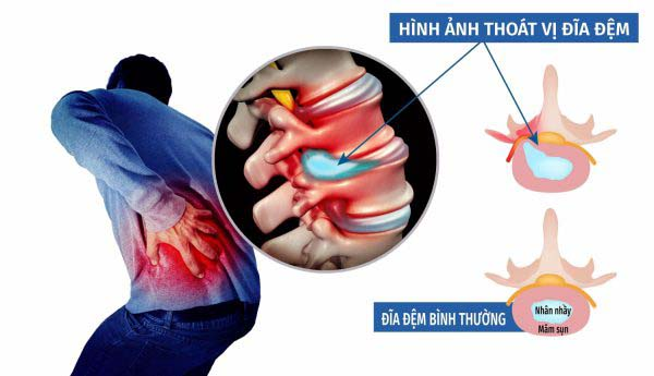 Thoát khỏi thoát vị đĩa đệm thần kỳ trong 3 tháng nhờ phương pháp của Đông Y An đông