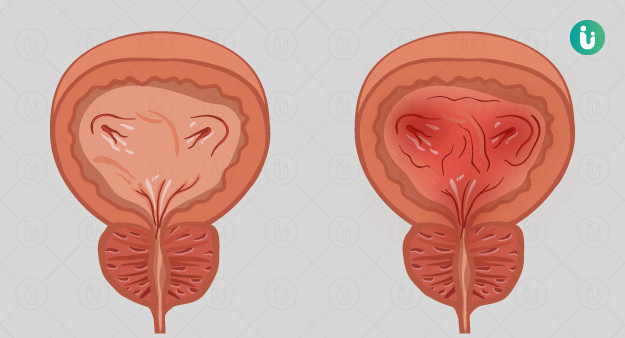 Viêm bàng quang xuất huyết: Nguyên nhân và điều trị