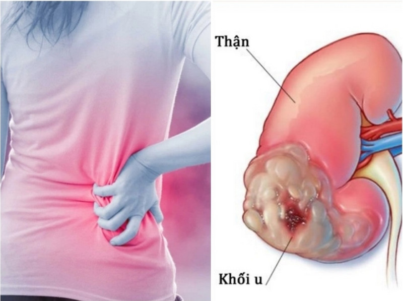 Xác định khối u của ung thư biểu mô tế bào thận di căn