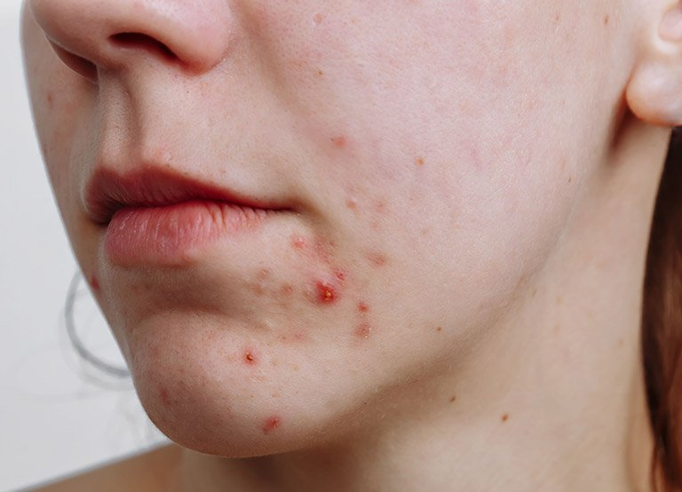 Chăm Sóc Da Mụn Thâm Như Thế Nào?
