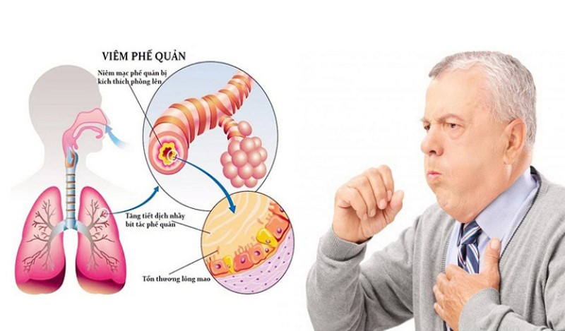 Người Bị Viêm Phế Quản Nên Ăn Gì?