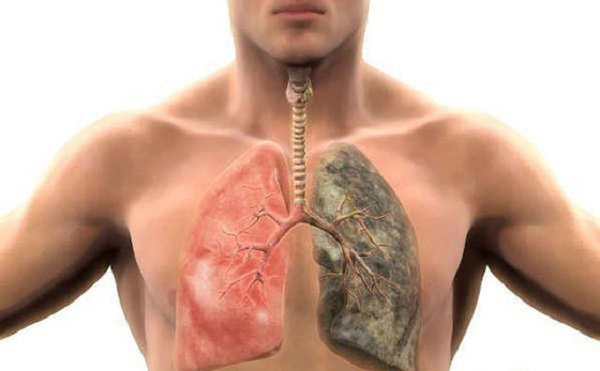 Viêm Phổi Do Hít Hóa Chất: Những Điều Cần Biết