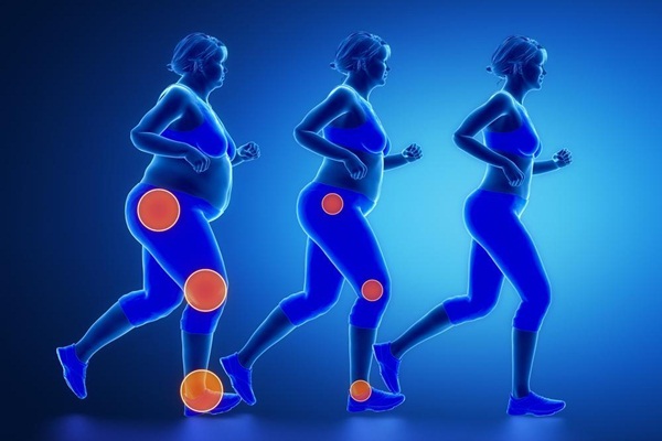 Mối liên hệ giữa bệnh loãng xương và béo phì