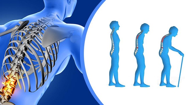 Loãng xương do glucocorticoid điều trị bằng cách nào?