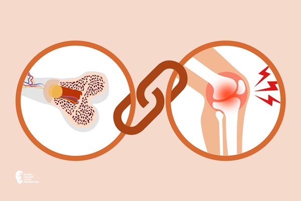 Mối liên hệ giữa bệnh viêm khớp và loãng xương