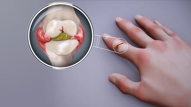 Nốt dạng thấp là gì? Điều trị bằng cách nào?