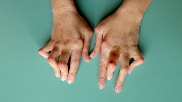 Nốt thấp khớp điều trị bằng cách nào?