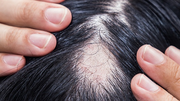 Viêm khớp dạng thấp có gây rụng tóc không?