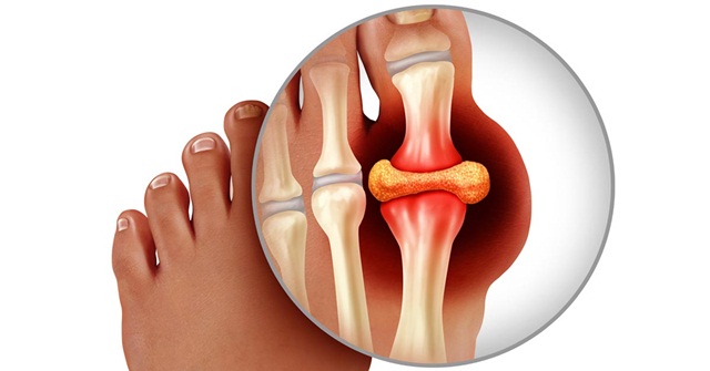 Có thể bị viêm khớp dạng thấp và bệnh gout cùng một lúc không?