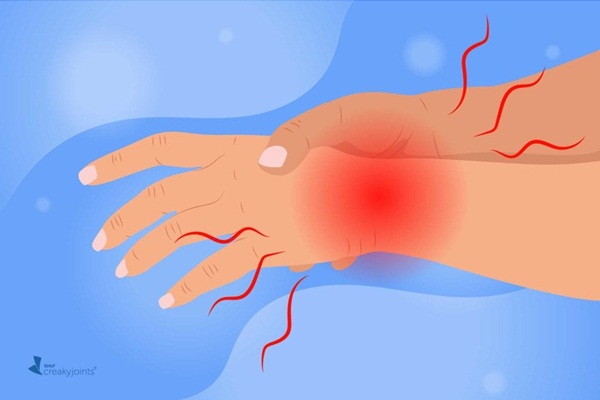 Các dấu hiệu và triệu chứng của bệnh viêm khớp dạng thấp